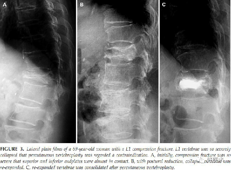 迟发性创伤后椎体塌陷，看看你到底了解了多少？