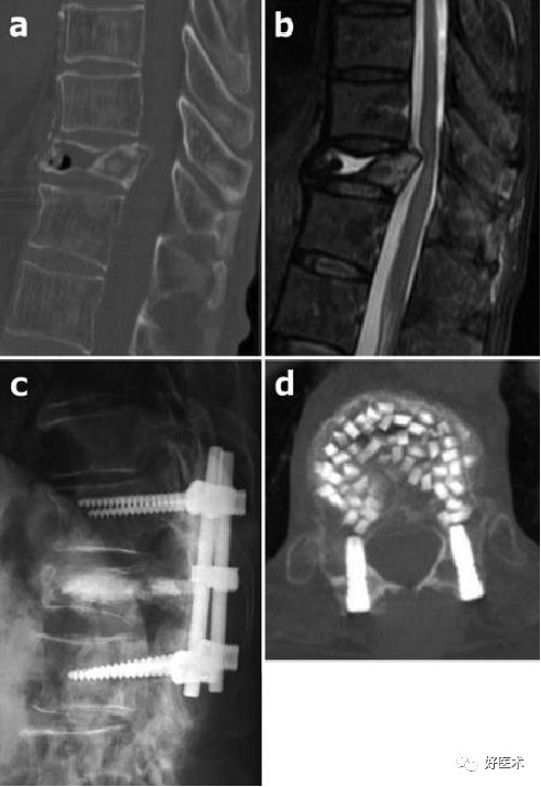 迟发性创伤后椎体塌陷，看看你到底了解了多少？