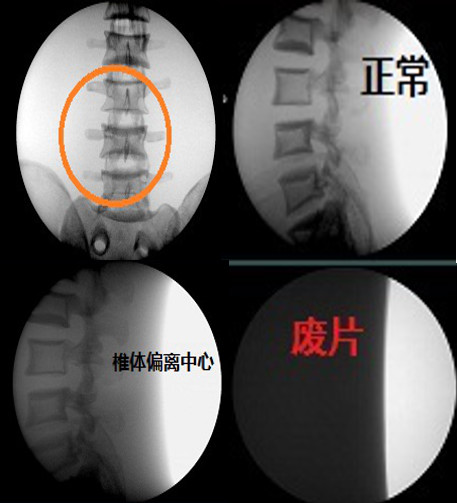 拿什么拯救你：长时间暴露在X射线下的骨科医生！