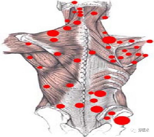 一篇文章全面了解：肌筋膜疼痛综合征！