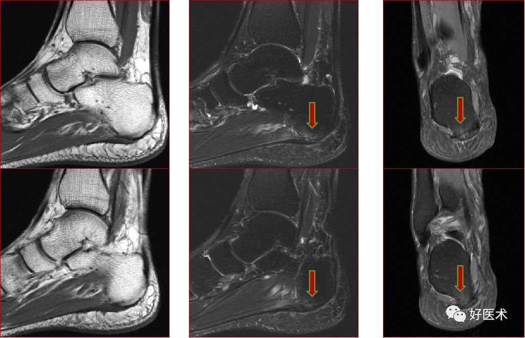踝关节MRI解剖与常见病变，都在这篇文章里！