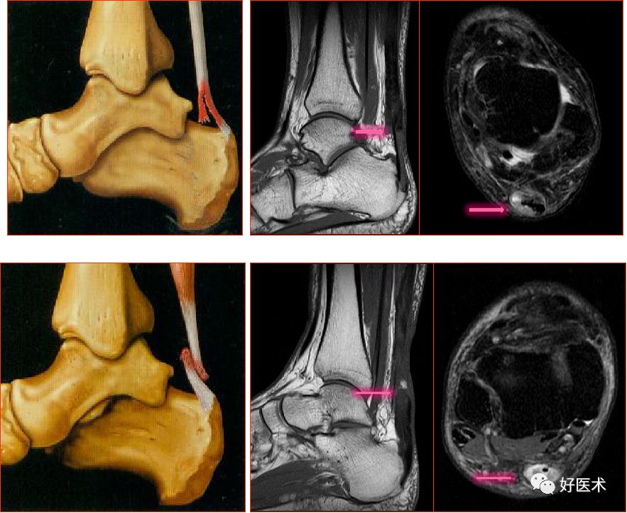 踝关节MRI解剖与常见病变，都在这篇文章里！