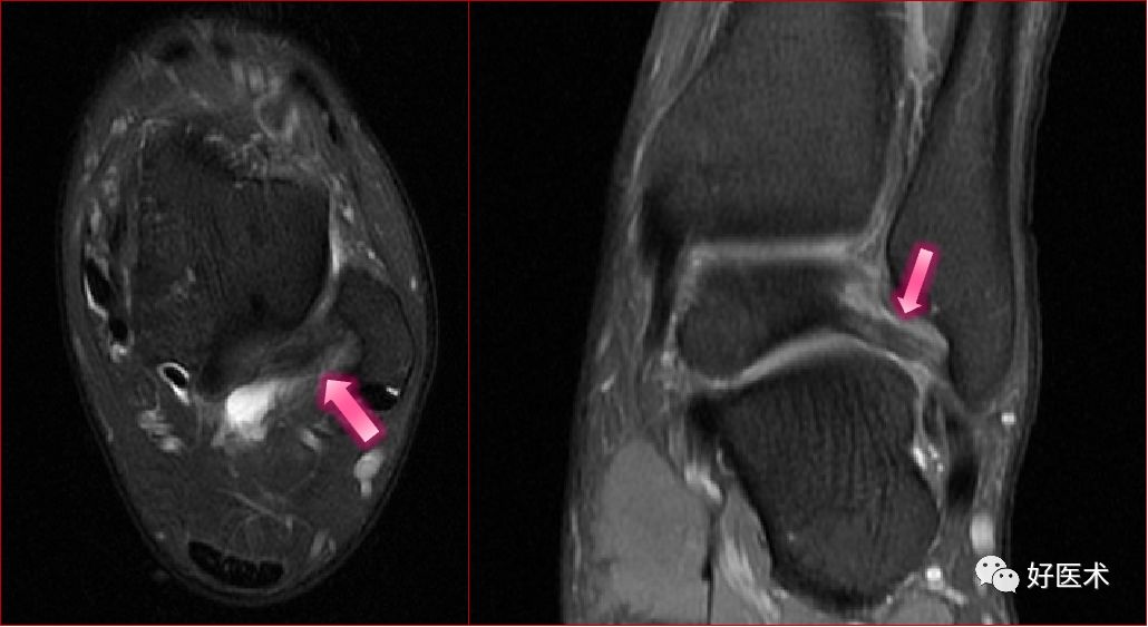 踝关节MRI解剖与常见病变，都在这篇文章里！