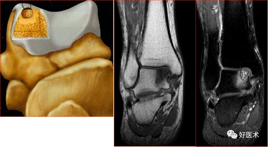 踝关节MRI解剖与常见病变，都在这篇文章里！