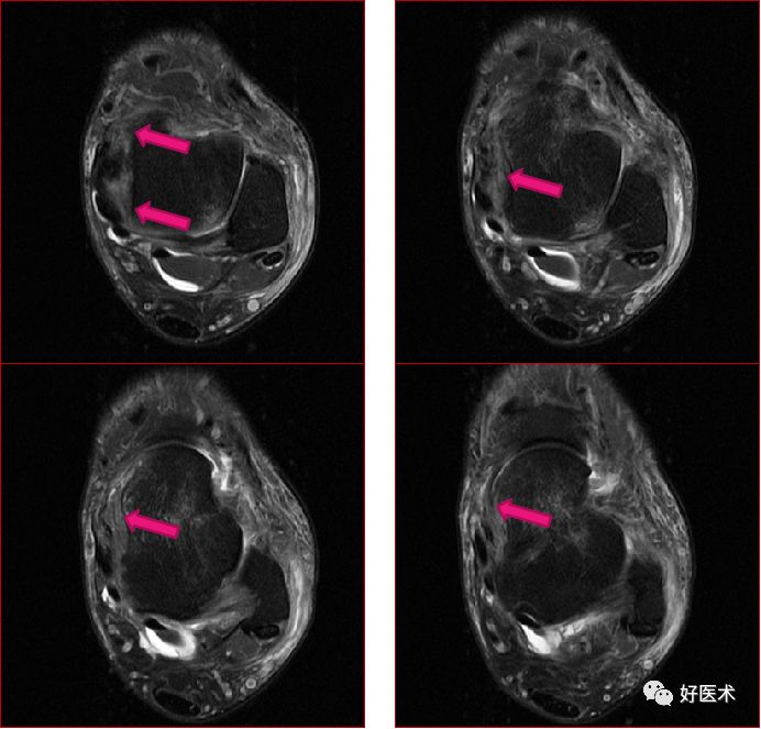 踝关节MRI解剖与常见病变，都在这篇文章里！
