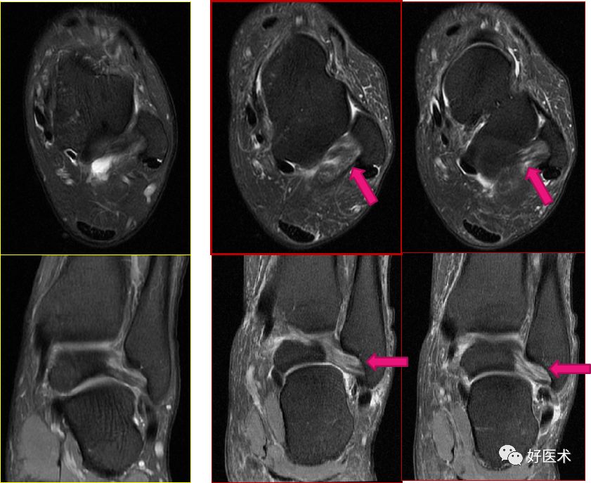 踝关节MRI解剖与常见病变，都在这篇文章里！