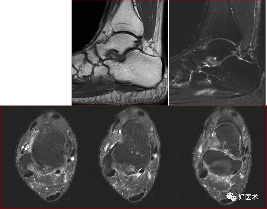 踝关节MRI解剖与常见病变，都在这篇文章里！