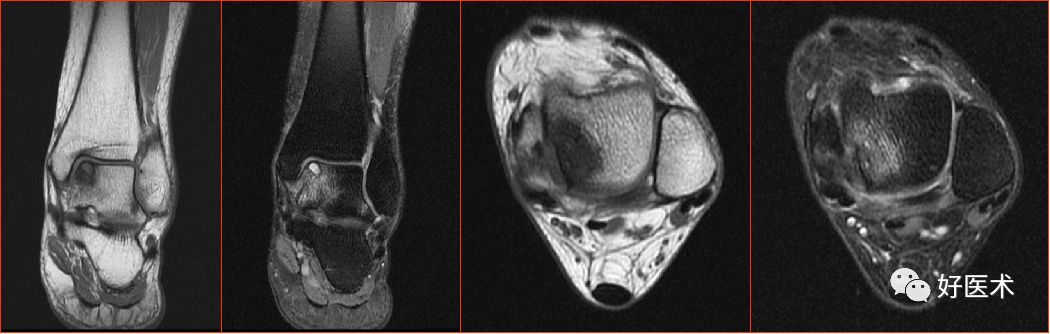 踝关节MRI解剖与常见病变，都在这篇文章里！
