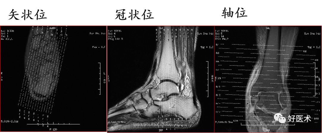 踝关节MRI解剖与常见病变，都在这篇文章里！