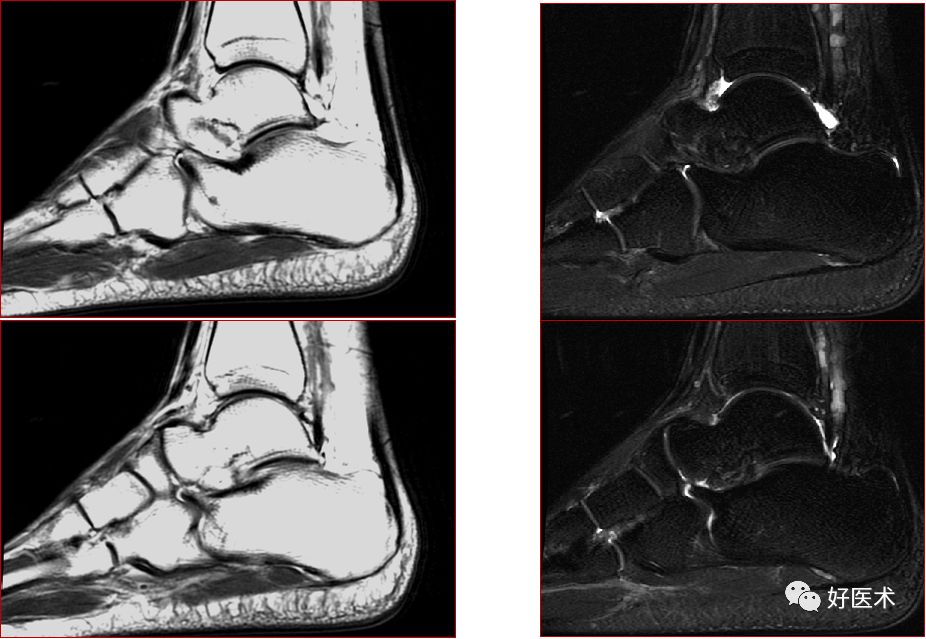 踝关节MRI解剖与常见病变，都在这篇文章里！