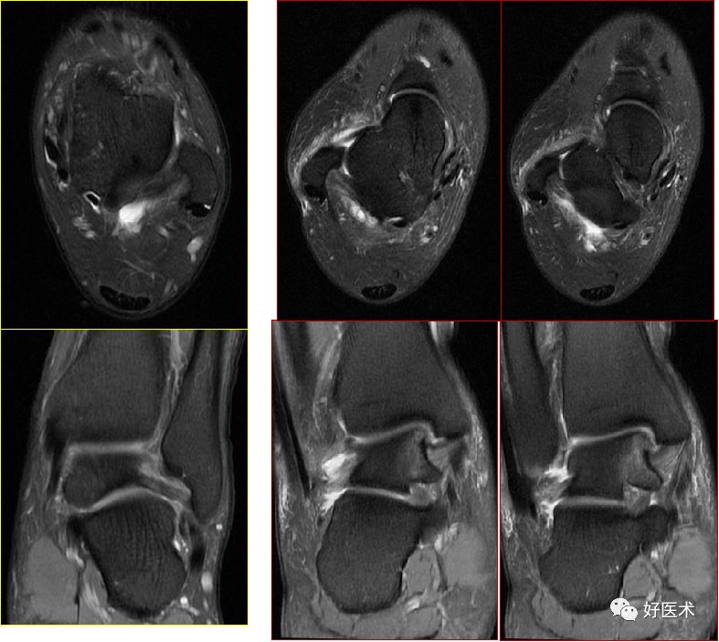 踝关节MRI解剖与常见病变，都在这篇文章里！