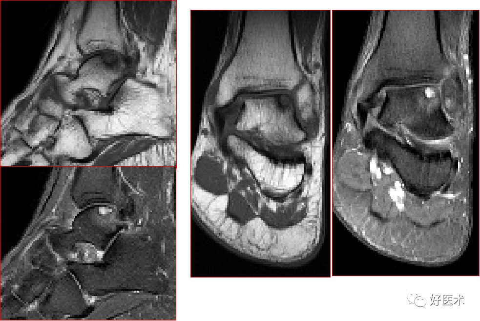 踝关节MRI解剖与常见病变，都在这篇文章里！