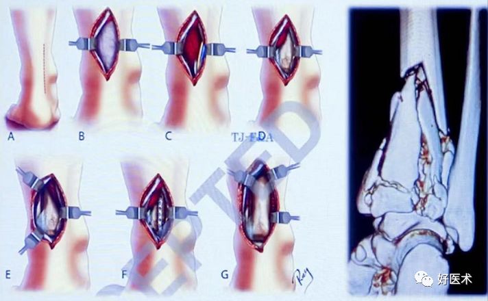 Pilon骨折手术入路最全总结，值得收藏！