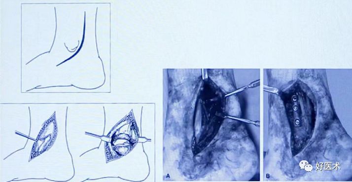 Pilon骨折手术入路最全总结，值得收藏！