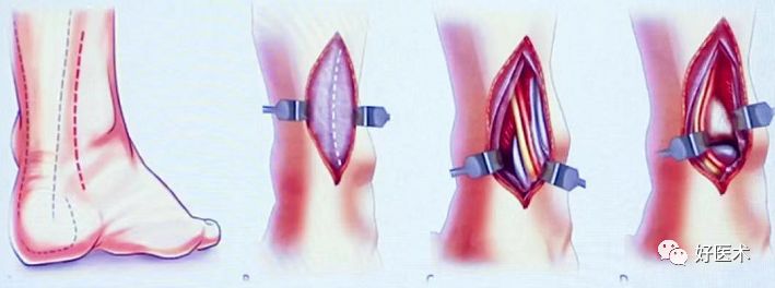 Pilon骨折手术入路最全总结，值得收藏！