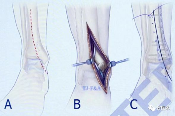 Pilon骨折手术入路最全总结，值得收藏！