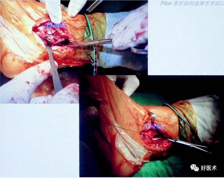 Pilon骨折手术入路最全总结，值得收藏！