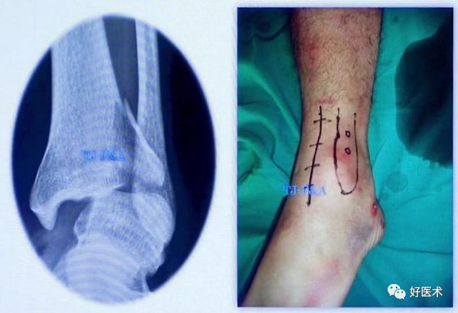 Pilon骨折手术入路最全总结，值得收藏！
