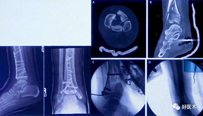 Pilon骨折手术入路最全总结，值得收藏！