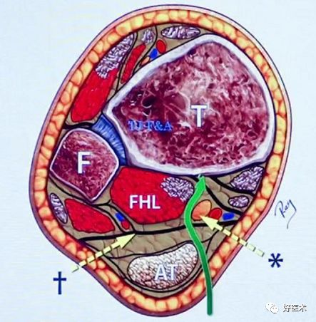 Pilon骨折手术入路最全总结，值得收藏！