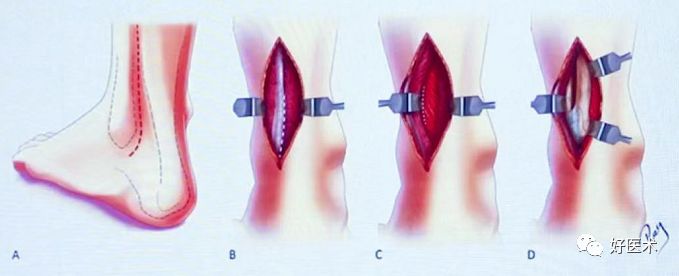 Pilon骨折手术入路最全总结，值得收藏！