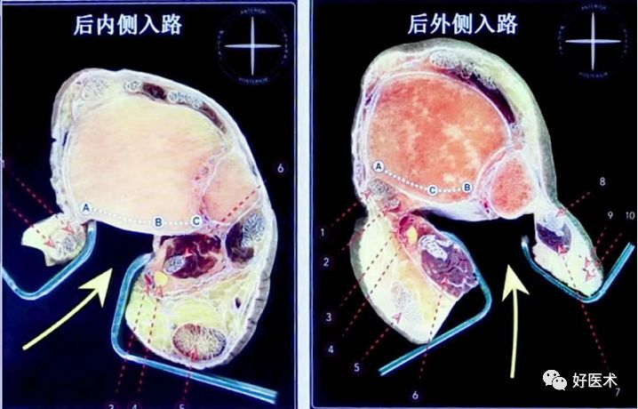 Pilon骨折手术入路最全总结，值得收藏！