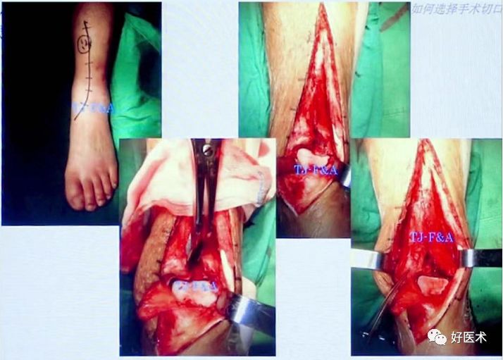 Pilon骨折手术入路最全总结，值得收藏！