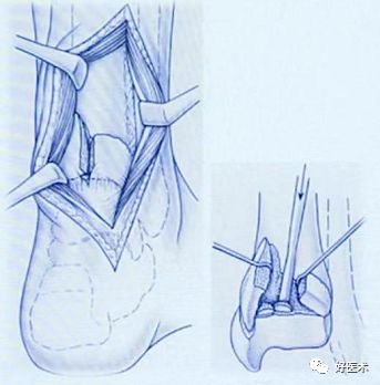 Pilon骨折手术入路最全总结，值得收藏！