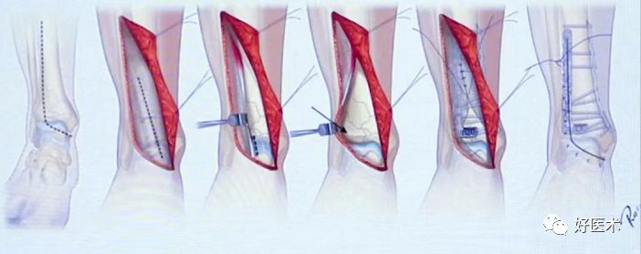 Pilon骨折手术入路最全总结，值得收藏！