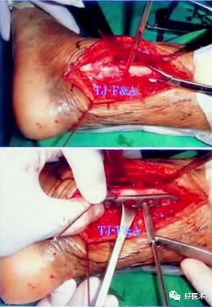 Pilon骨折手术入路最全总结，值得收藏！
