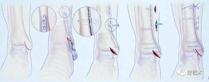 Pilon骨折手术入路最全总结，值得收藏！