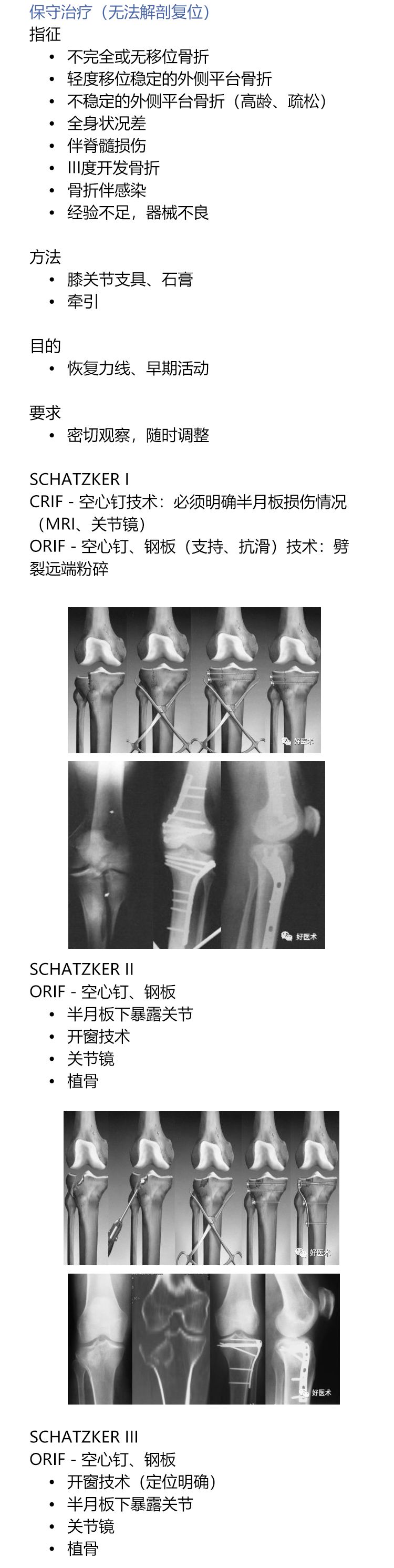 一目了然！5张图教你做好胫骨平台骨折！