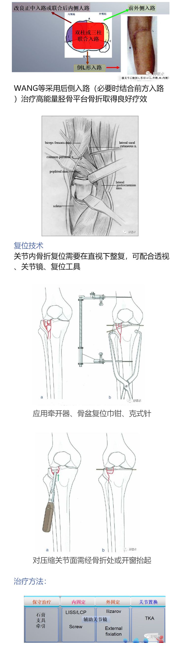 一目了然！5张图教你做好胫骨平台骨折！