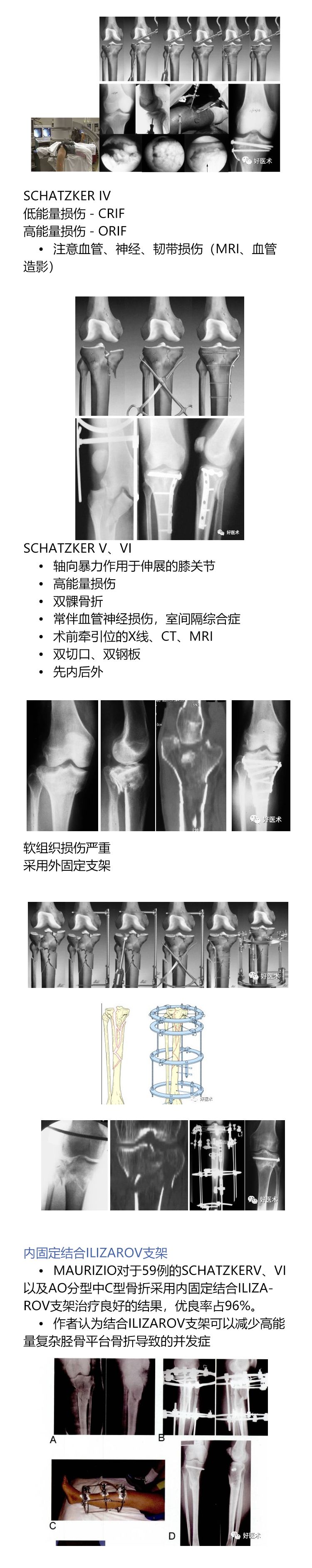 一目了然！5张图教你做好胫骨平台骨折！