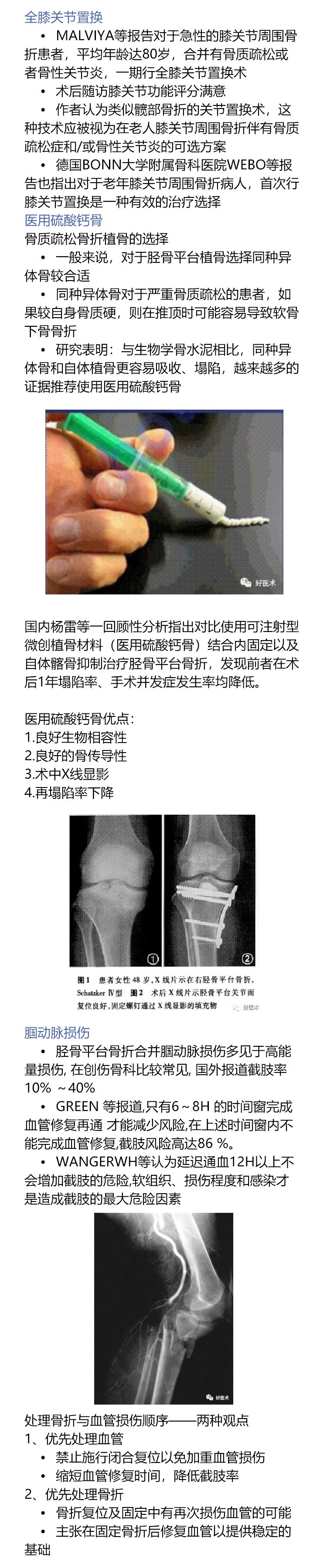 一目了然！5张图教你做好胫骨平台骨折！