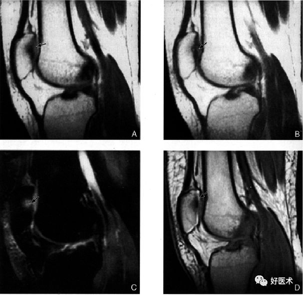 8分钟带您系统学习:髌骨软化症诊治要点!