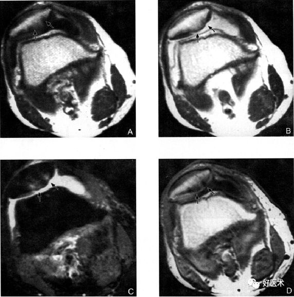 8分钟带您系统学习:髌骨软化症诊治要点!
