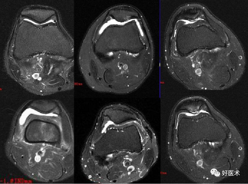 8分钟带您系统学习:髌骨软化症诊治要点!