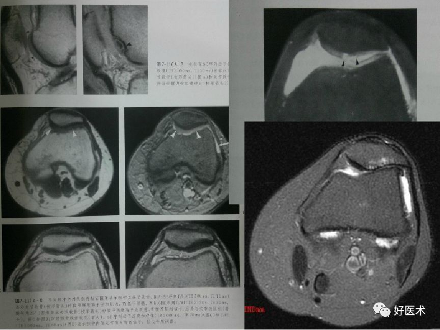 8分钟带您系统学习:髌骨软化症诊治要点!
