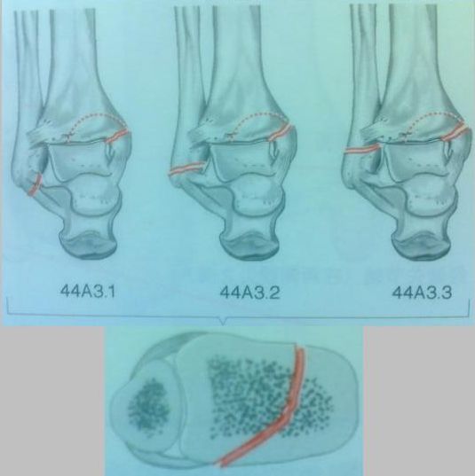 踝关节骨折如何分型？这篇文章告诉你！