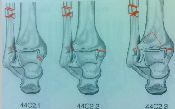 踝关节骨折如何分型？这篇文章告诉你！
