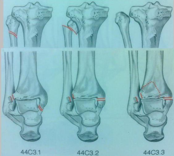 踝关节骨折如何分型？这篇文章告诉你！