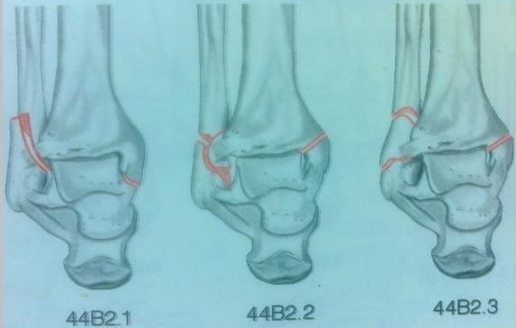 踝关节骨折如何分型？这篇文章告诉你！