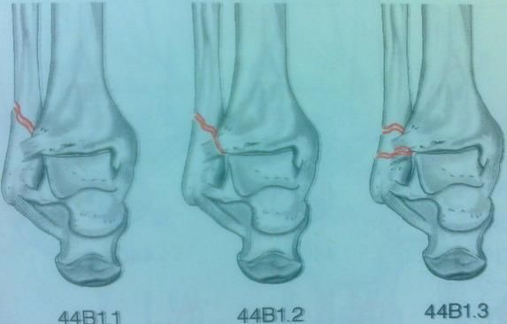 踝关节骨折如何分型？这篇文章告诉你！
