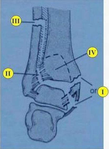 踝关节骨折如何分型？这篇文章告诉你！