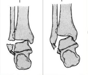 踝关节骨折如何分型？这篇文章告诉你！
