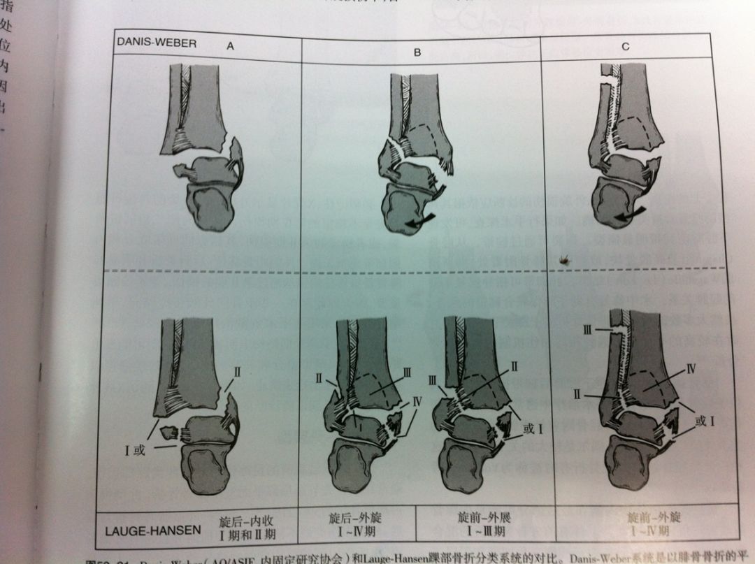 踝关节骨折如何分型？这篇文章告诉你！