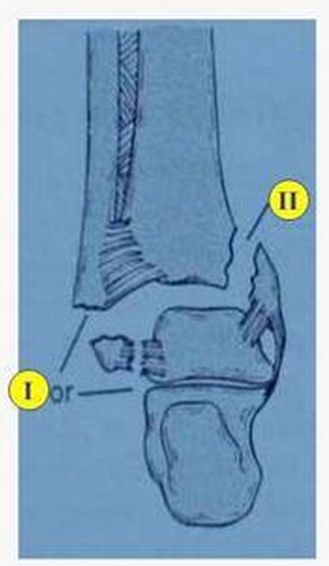 踝关节骨折如何分型？这篇文章告诉你！