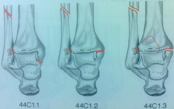 踝关节骨折如何分型？这篇文章告诉你！