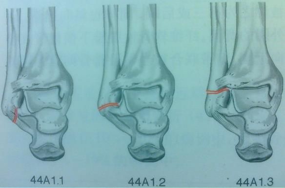 踝关节骨折如何分型？这篇文章告诉你！